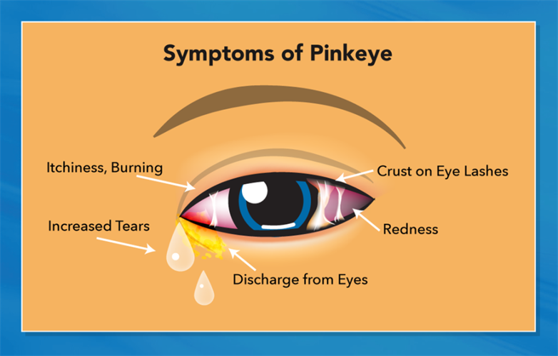 pinkeye-conjunctivitis-in-children